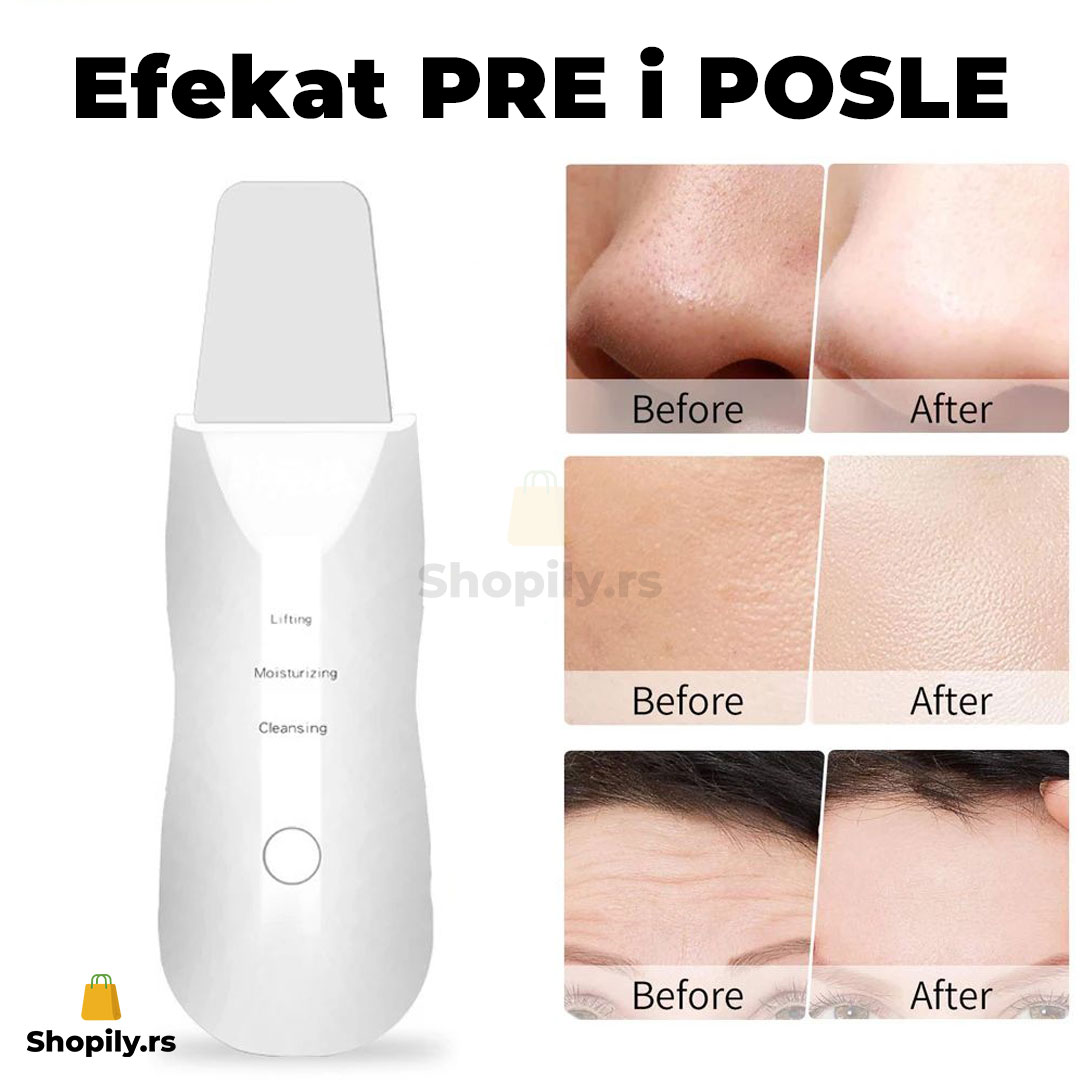 Ultrazvučna spatula za čišćenje lica